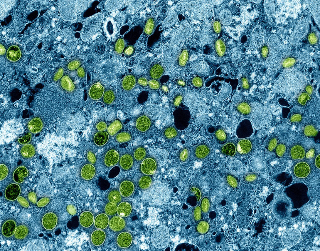 India's first case of Mpox Clade 1b registered in Kerala